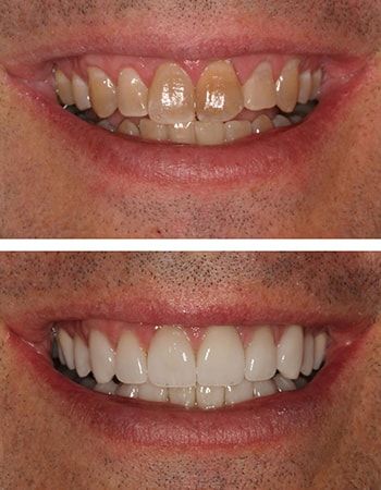 Before and after porcelain veneers