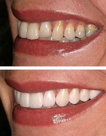 Before and after Instant orthodontics