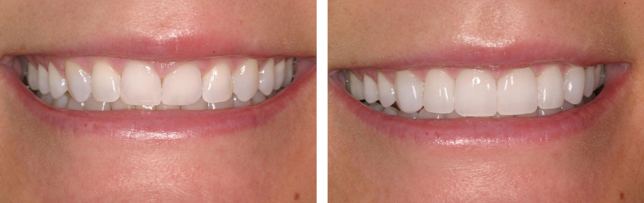 Before and after prepless veneers